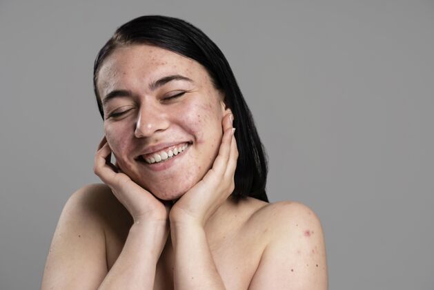 油性皮肤年轻女子自信地露出她的粉刺粉刺健康护理